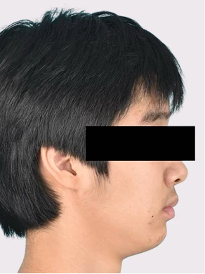 어린이 교정 후 측면 사진